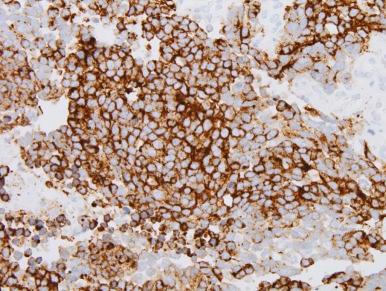 Figure 57-16, Synaptophysin immunohistochemical staining of medulloblastoma (×400).