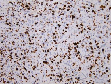 Figure 57-17, Ki-67 immunohistochemical staining in glioblastoma multiforme (×200).