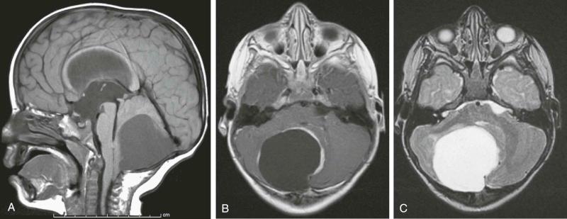 Figure 57-18, Posterior fossa pilocytic astrocytoma (juvenile pilocytic astrocytoma). A, A sagittal T1-weighted image without use of contrast material. B, An axial T1-weighted image with use of contrast material. C, An axial T2-weighted image.