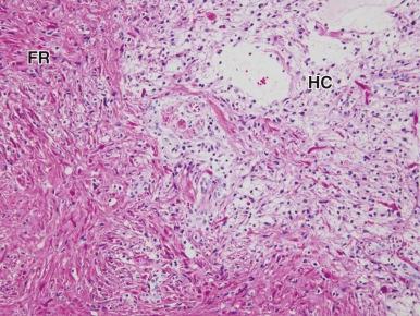 Figure 57-19, Pilocytic astrocytoma. Shown is a biphasic pattern of compact, fiber-rich (FR) tumor and hypocellular (HC) areas with microcysts (×200).