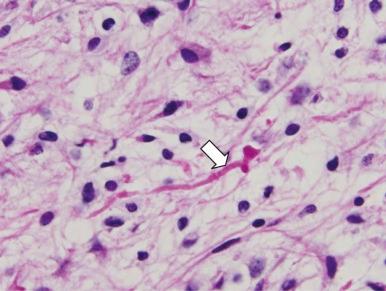 Figure 57-20, Rosenthal fiber (arrow) in a pilocytic astrocytoma (hematoxylin and eosin; ×1000).