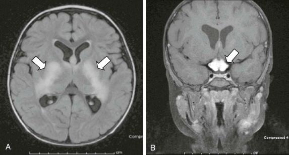 Figure 57-21, A large optic pathway glioma in a 2-year-old boy who does not have neurofibromatosis type 1. A, An axial T2-weighted fluid-attenuated inversion recovery image that demonstrates bilateral involvement of the optic tracts posterior to the chiasm (arrows). B, A T1-weighted gadolinium-enhanced coronal image demonstrating the enhancing tumor expanding the optic chiasm (arrow). The patient has no functional vision and is legally blind.