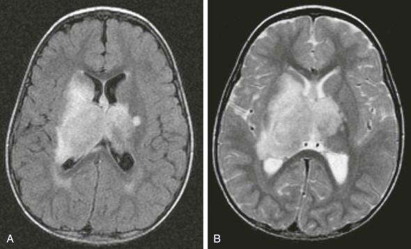 Figure 57-22, Bithalamic astrocytoma. A, An axial fluid-attenuated inversion recovery image. B, An axial T2-weighted image.