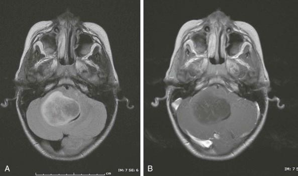 Figure 57-23, Grade II fibrillary astrocytoma. A, An axial fluid-attenuated inversion recovery image. B, An axial T1-weighted image with use of contrast material showing a noncontrast-enhancing fibrillary tumor.