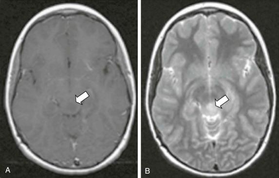 Figure 57-24, Tectal glioma. A, An axial T1-weighted image with use of contrast material showing a noncontrast-enhancing tectal tumor (arrow). B, An axial T2-weighted image shows T2 hyperintense lesion in the tectum (arrow) .