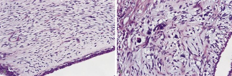 FIG. 16.12, Phyllodes tumor. (A) In this example of a benign phyllodes tumor, little nuclear pleomorphism is seen. (B) Marked nuclear atypia is seen in the stromal cells of this malignant lesion with an abnormal mitosis.