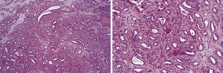 FIG. 16.13, Sclerosing adenosis. (A) Low-power view showing a nodular disorganized proliferation of epithelial glands and intralobular stroma. (B) Foci of microcalcification are present within microtubular structures.