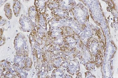 FIG. 16.14, Sclerosing adenosis. The myoepithelial component is clearly identified by immunostaining for anti–smooth muscle actin.