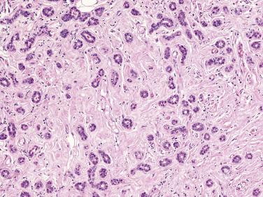 FIG. 16.15, Microglandular adenosis. Small, rounded acinar structures are present in an irregular distribution within fibrous and adipose tissue.