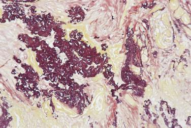 FIG. 16.18, Complex sclerosing lesion, stained with elastic van Gieson to demonstrate the marked central elastosis.