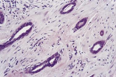 FIG. 16.19, Fibrous and elastic tissue in the center of this complex sclerosing lesion surround entrapped tubules in which two layers of epithelium can be distinguished.