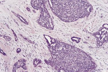 FIG. 16.20, Epithelial hyperplasia of usual type is seen within this complex sclerosing lesion, merging with entrapped tubules.