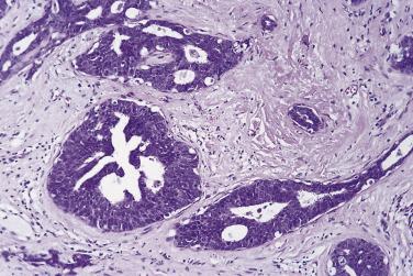 FIG. 16.21, Atypical ductal hyperplasia in a radial scar, with adjacent elastosis and entrapped tubule.