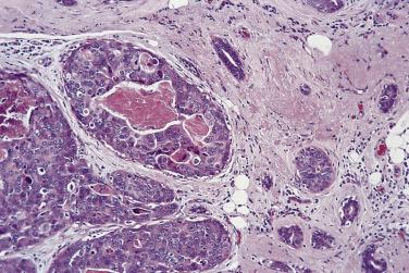 FIG. 16.22, Complex sclerosing lesion. Elastosis surrounds entrapped tubules (right), and ductal carcinoma in situ of comedo type is present (left).