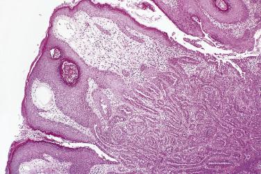 FIG. 16.25, Nipple adenoma. A proliferation of glandular structures arises from the nipple ducts close to the skin surface.