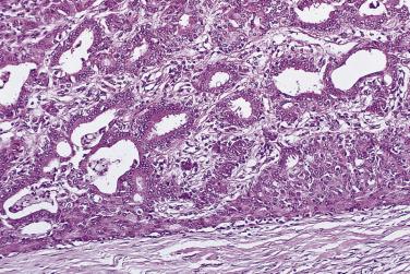 FIG. 16.28, Ductal adenoma. A distended duct space filled with a complex mixture of epithelial-lined glandular structures, myoepithelial cells, and stromal tissue.