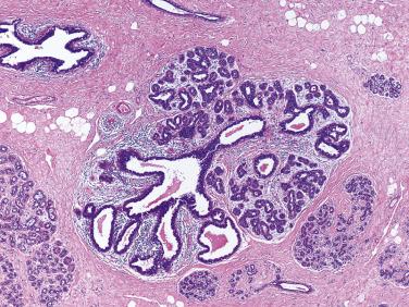 FIG. 16.29, Columnar cell change involving a terminal duct lobular unit.