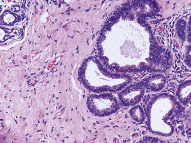 FIG. 16.30, Columnar cell change. Note the polarized nature of the cells with basally placed ovoid nuclei.