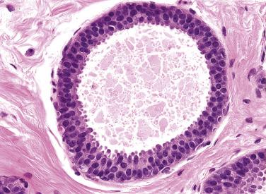 FIG. 16.32, Flat epithelial atypia (FEA). The cells in FEA appear less columnar in morphology with more rounded nuclei and loss of polarization.