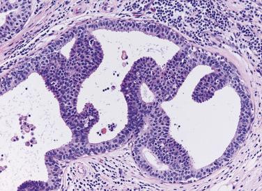 FIG. 16.34, Atypical ductal hyperplasia arising in a background of flat epithelial atypia. Note the presence of both architectural and cytonuclear atypia, which establishes the diagnosis of atypical ductal hyperplasia in this case.