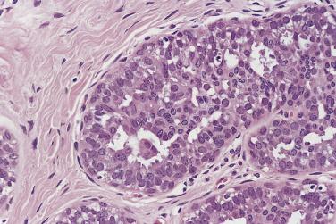 FIG. 16.35, Usual type epithelial hyperplasia. An example of mild epithelial hyperplasia. An increase occurs in the number of epithelial cells above the basement membrane with preservation of the myoepithelial layer. Epithelial cells form bridges that cross the luminal space. The residual spaces are irregular in shape and size and have a typical slitlike appearance.