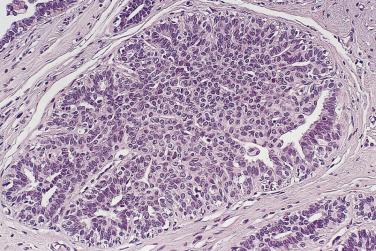 FIG. 16.37, Usual epithelial hyperplasia. A good example showing all the cardinal features. Although epithelial cells predominate, some myoepithelial and lymphoid cells are present.