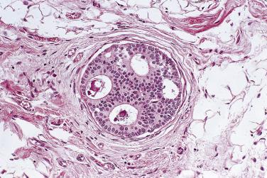 FIG. 16.38, Atypical ductal hyperplasia. This small duct space is filled by a relatively uniform single population of epithelial cells that have formed distinctive punched-out luminal spaces. Some polarization of the cells around the luminal spaces is present.