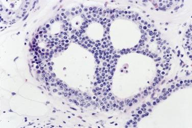 FIG. 16.39, Atypical ductal hyperplasia. A dilated ductal space containing a proliferation of regular epithelial cells forming relatively uniform luminal holes. This population of cells has not replaced the normal ductal lining cells but appears to rest on top of them.