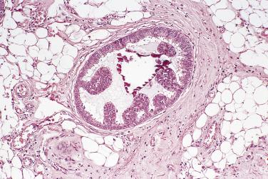 FIG. 16.40, Atypical ductal hyperplasia. Micropapillary variants are recognized where clusters of uniform epithelial cells protrude from the population of duct-lining cells into the lumen.