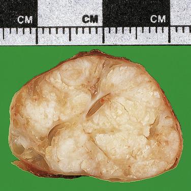 FIG. 16.4, A benign fibroadenoma; note the circumscribed outline and a lobulated cut surface.