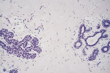 FIG. 16.42, Lobular neoplasia. Atypical lobular hyperplasia. Two adjacent terminal duct lobular units. Right, The acini are lined by the normal bilayer of cells; left, a population of cells resembling the normal lining cells is seen, representing mild atypical lobular hyperplasia.