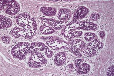 FIG. 16.43, Lobular neoplasia. Atypical lobular hyperplasia. A terminal duct lobular unit showing proliferation of a population of uniform small cells. Some of the acini are filled, but the majority show residual luminal space.