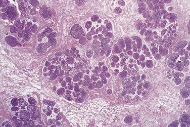 FIG. 16.44, Lobular neoplasia. Lobular carcinoma in situ. There is complete filling and marked distention of the terminal duct lobular units by a population of small cells resembling the normal acinar lining cells.