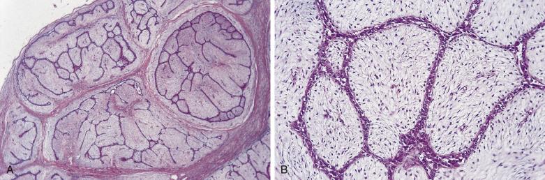 FIG. 16.5, Fibroadenoma. In this example the lesion demonstrates a typical intracanalicular pattern. The nodular structure is evident in (A), whereas the characteristic combination of epithelial clefts and cellular intralobular stroma is seen in (B).