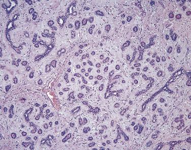 FIG. 16.6, Fibroadenoma with a pericanalicular pattern.