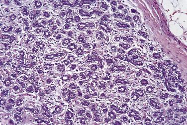 FIG. 16.8, Tubular adenoma. Numerous small tubular structures composed mainly of secretory epithelial cells but with less obvious myoepithelial cells are set in a fine cellular stroma.