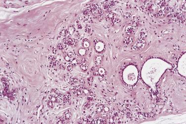 FIG. 16.9, Hamartoma of breast. Ill-defined lobular structures and ducts are situated within a hyalinized connective tissue stroma.