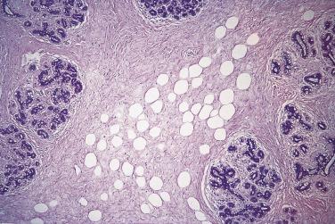 FIG. 16.10, Hamartoma of breast. This section was taken from the center of a large mass lesion and shows an architecture of lobular structures, stroma, and adipose tissue.