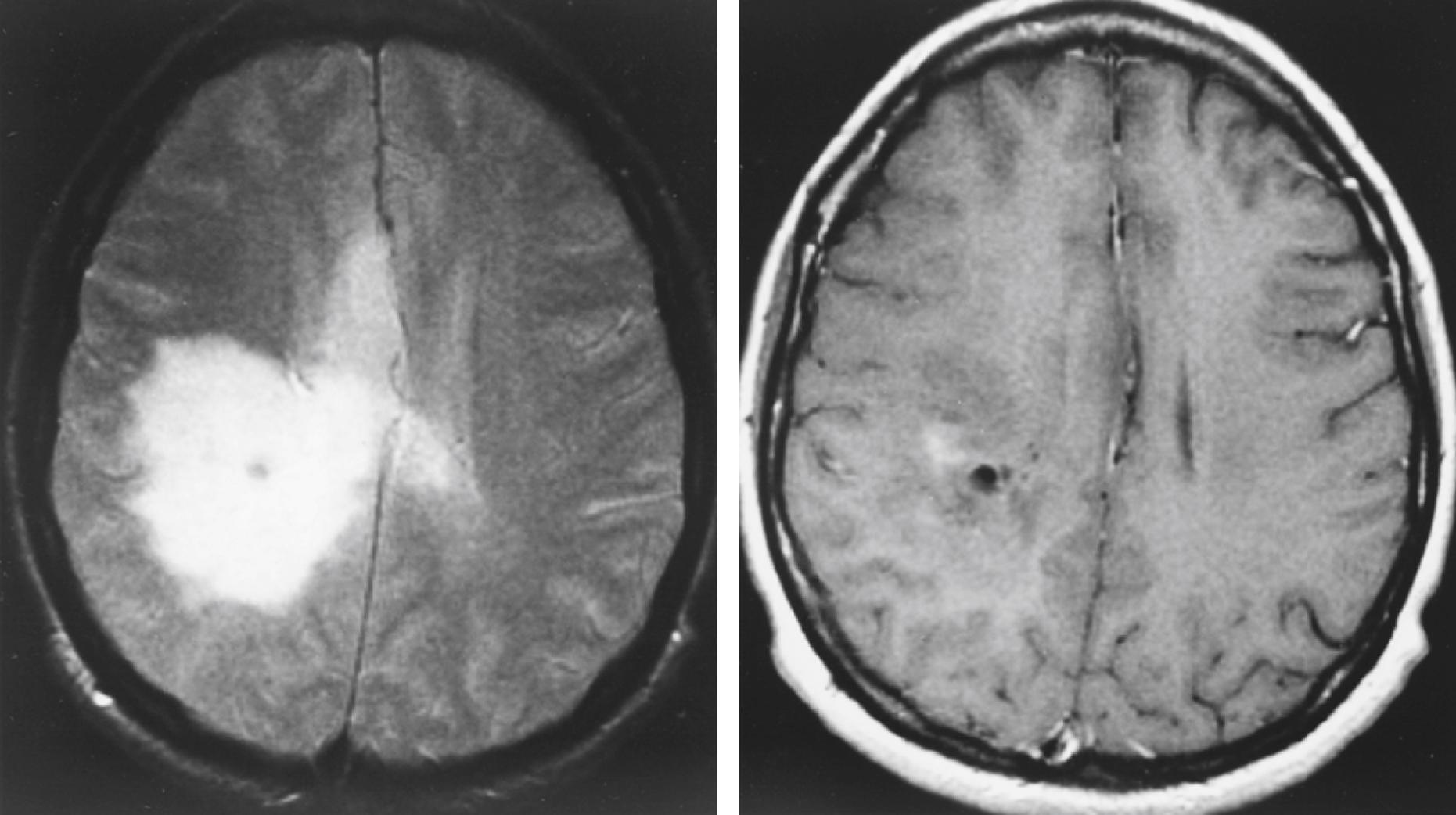 FIGURE 175-1, Glioma.