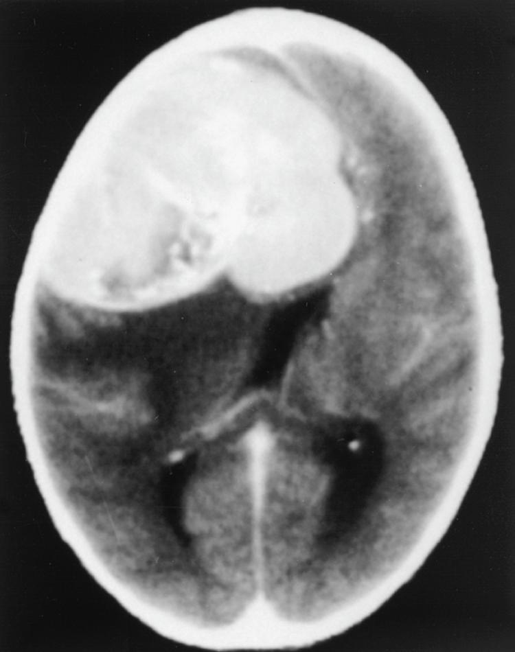 FIGURE 175-2, Meningioma.