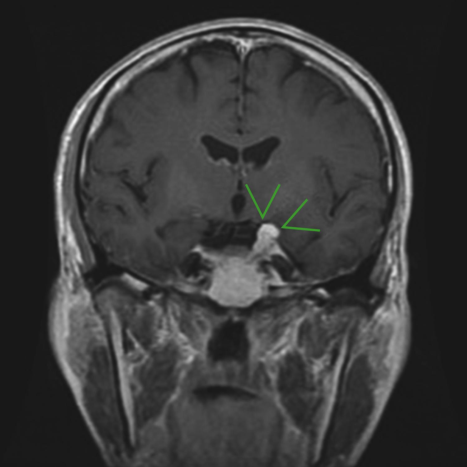 FIGURE 175-3, Skull base meningioma.