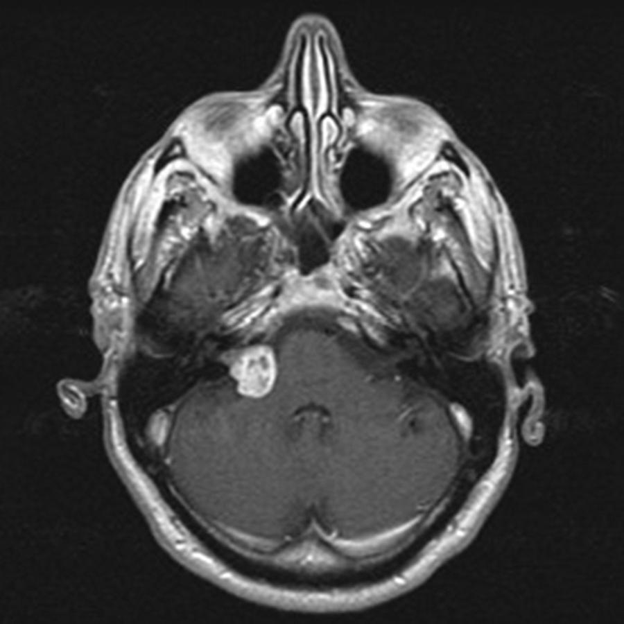 FIGURE 175-4, Vestibular schwannoma.