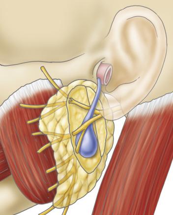 FIG. 30.1, A diagrammatic representation of the relationship of a first branchial cleft anomaly to the external auditory canal, parotid gland, and facial nerve branches. The lesion may present retroauricular or below the parotid gland (dotted lines) .