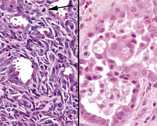 FIG. 30.11, (Left) There is a remarkably pleomorphic appearance to the epithelial cells of a ceruminous adenocarcinoma, NOS in which there is a mitotic figure (arrow), and decapitation type secretions in the luminal component. (Right) Ceruminous mucoepidermoid carcinoma shows a glandular configuration with mucinous and transitional cells.