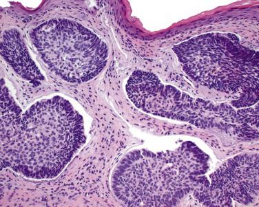 FIG. 30.13, Skin basal cell carcinoma shows nests of basaloid cells with peripheral palisading and stromal retraction artifact.