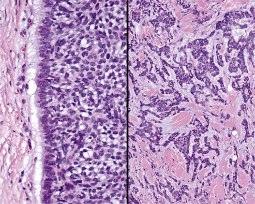 FIG. 30.14, Basal cell carcinoma. (Left) High power shows the retraction artifact between the tumor cells and the stroma. (Right) Intratumoral fibrosis separates the tumor islands in this desmoplastic variant of BCC.