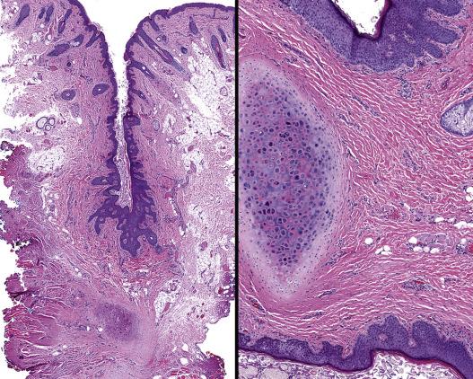 FIG. 30.2, Cartilage adjacent to a squamous lined cyst in these Work Type II lesions.