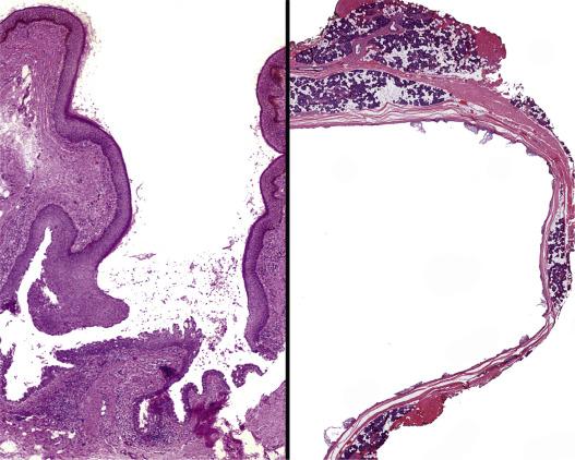 FIG. 30.3, Work Type I. A blind sinus, showing focal respiratory type epithelium at the base (left). A cystic space within the parotid gland showing a thin, attenuated squamous epithelium removed from a 24-year-old patient (right).
