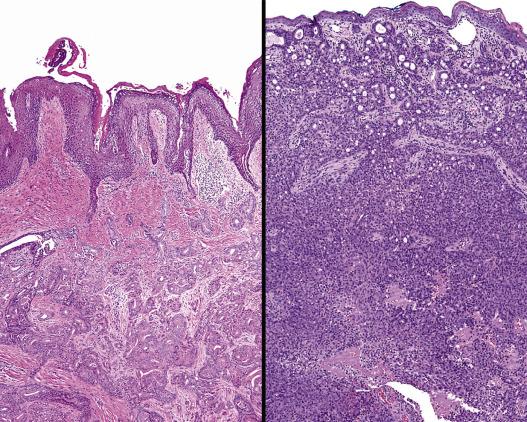 FIG. 30.4, Ceruminous adenoma. An intact squamous mucosa covers the unencapsulated ceruminous adenoma. Note the prominent stromal (left).