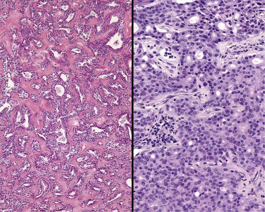 FIG. 30.5, The biphasic nature of the proliferation is easily identified, but the prominent stromal reaction can simulate an invasive tumor.